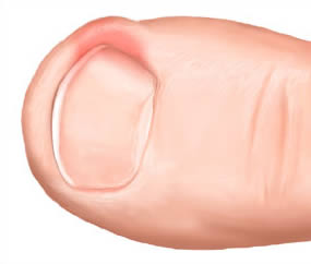podologo-malaga-una-encarnada-dolor-dedo-uña-dedo-gordo