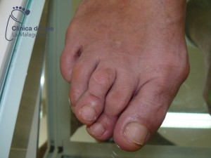 podólogo málaga: cirugía juanetes