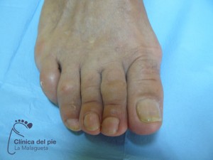 podólogo málaga: cirugía juanetes despues