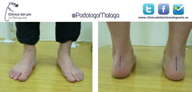 Índice de Postura del Pie podologo malaga podologo en malaga, podologia en malaga, podologo malaga